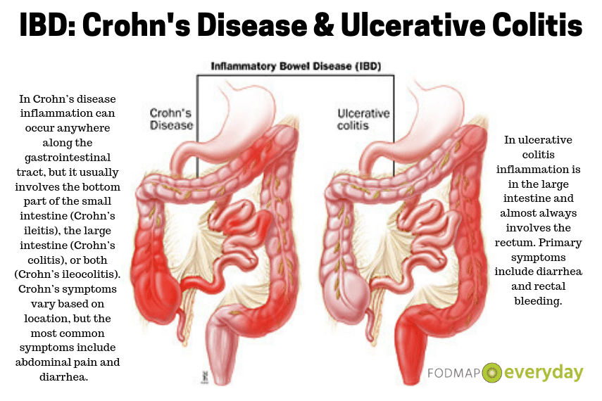 Graphic with two illustrations of the digestive tracts, one depicting Crohn's disease and the other depicting Ulcerative colitis