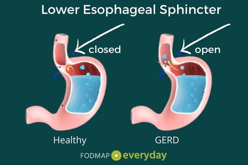 Drawing of healthy and GERD version of the esophageal sphincter