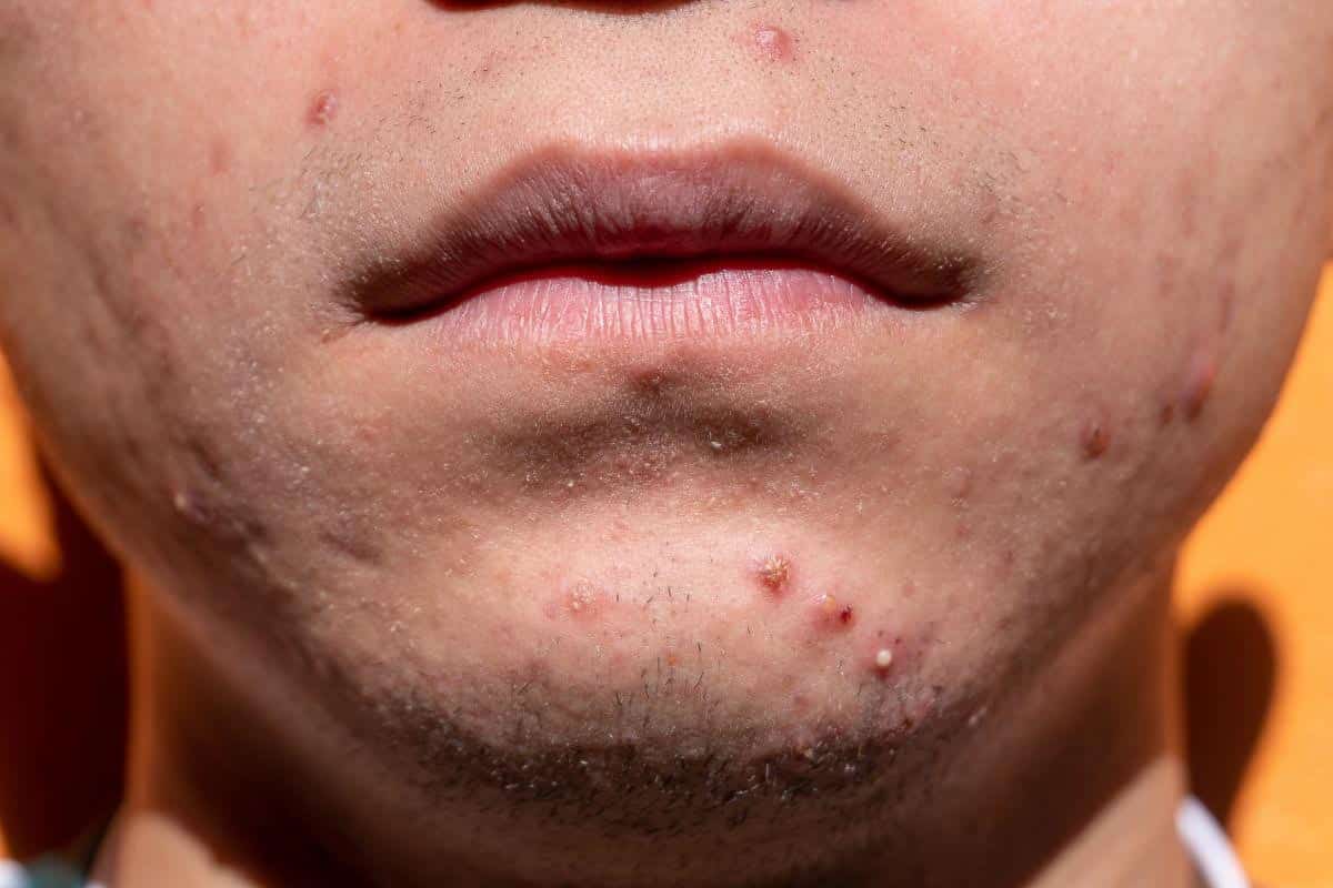 person with bad chin acne.