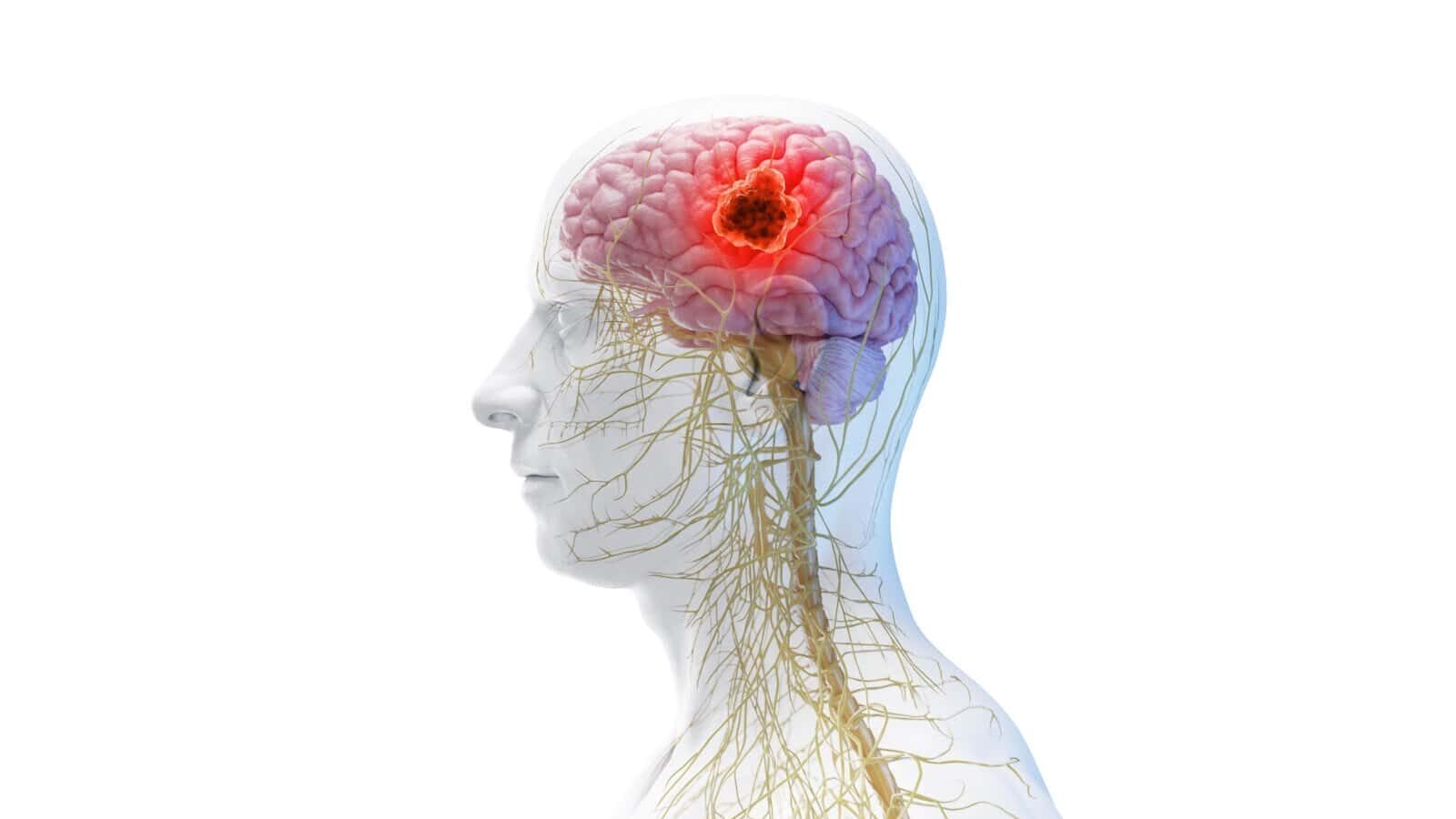 brain tumor graphic
