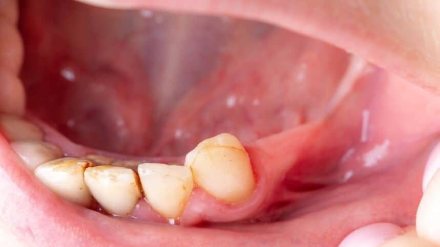 Bad teeth