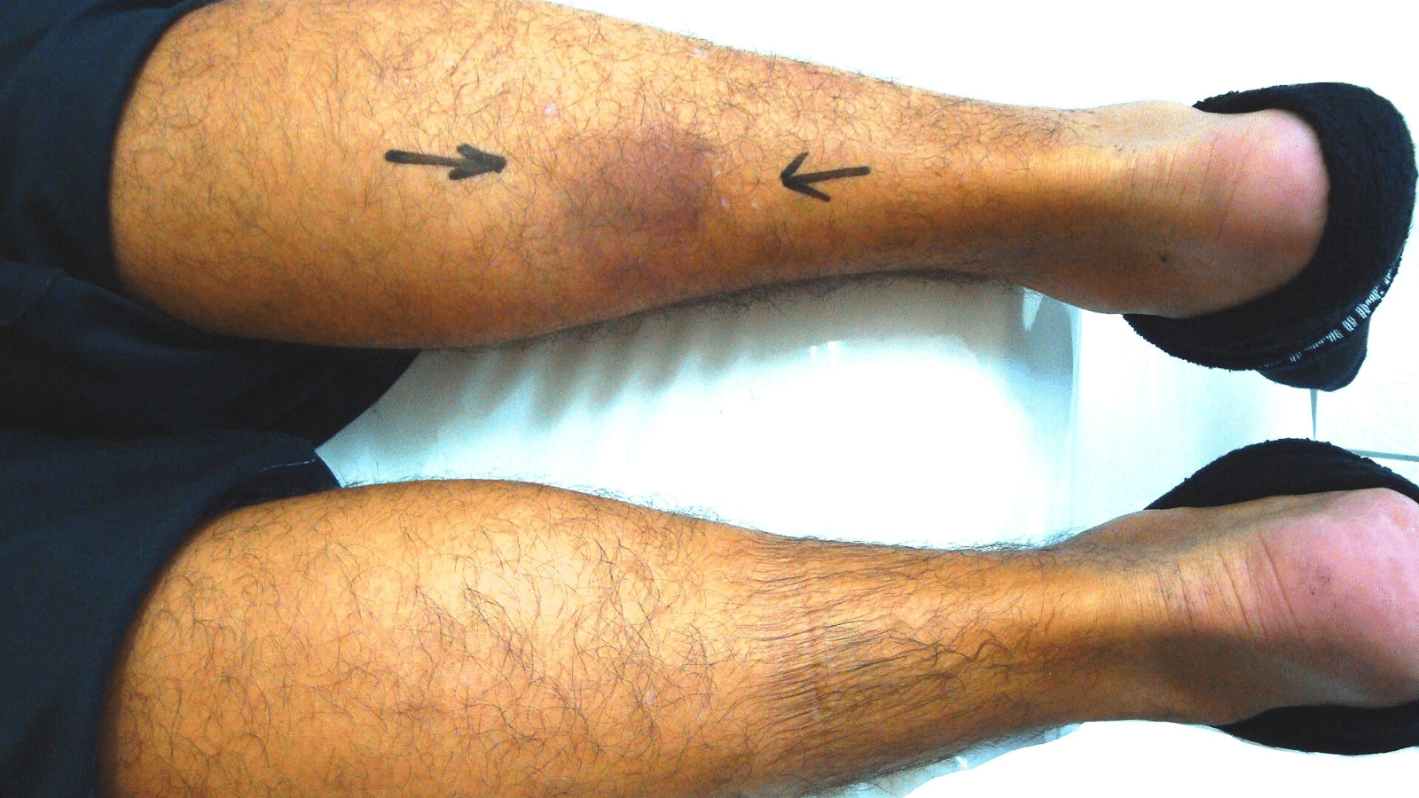 Calf Muscles