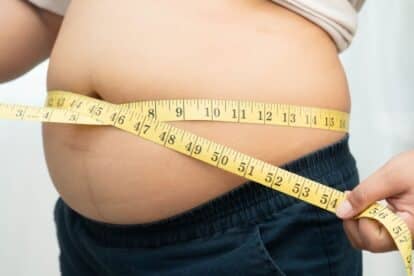 overweight and obesity